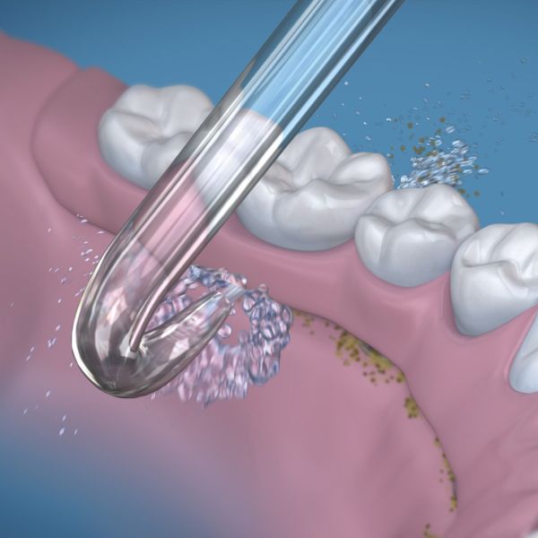 反向噴頭<br>Implant Denture Tip<br>DT-100E