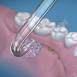 反向噴頭<br>Implant Denture Tip<br>DT-100E